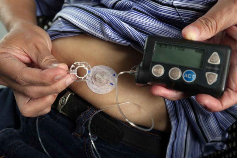 Insulin Pump